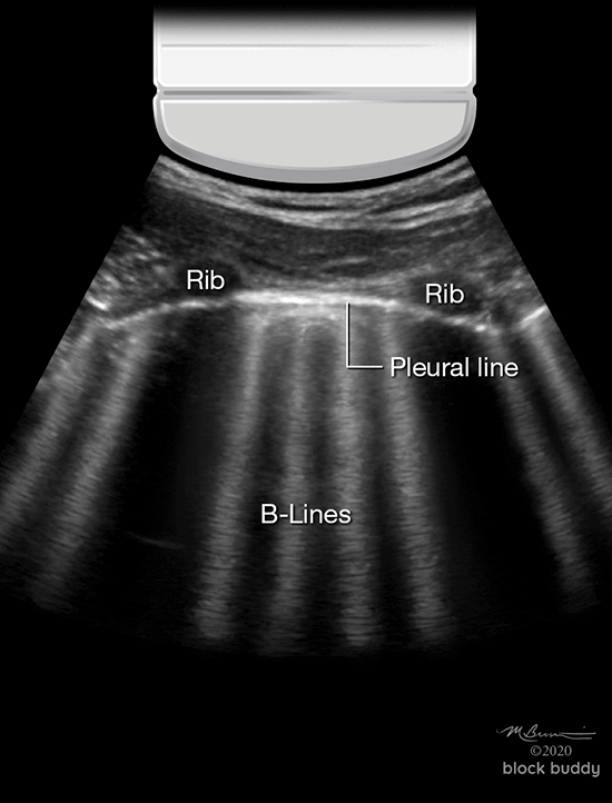 10-B-lines_1050x800 COVID-19 Lung Ultrasound Abnormal Lung Scan