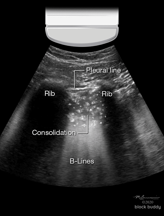 11-Consolidation_1050x800 COVID-19 Lung Ultrasound Abnormal Lung Scan Consolidation