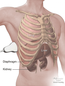 12-Effusion-Probe_1050x800-229x300 COVID-19 Lung Ultrasound Pleural Effusion Illustration
