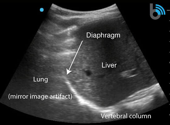 13-Lung-no-effusion COVID-19 Lung Ultrasound Pleural Effusion Scan