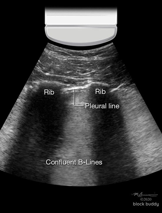 14a-Confluent-B-lines_1050x800 COVID-19 Lung Ultrasound Pulmonary Edema