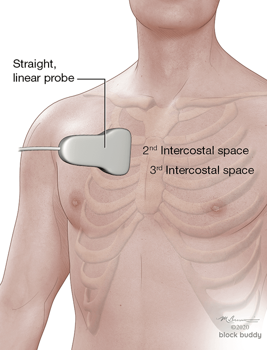 16-Linear-Probe_1050x800 COVID-19 Lung Ultrasound Pneumothorax Diagram