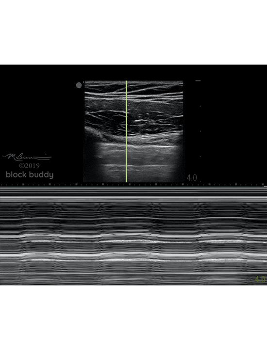 17-Lung-M-Mode_1050x800_Final (1) COVID-19 Lung Ultrasound