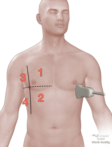 2-Ant-Zones-1050x800-229x300 COVID-19 Lung Ultrasound Lung Area Numbered Illustration