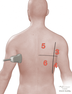 3-Post-Zones-1050x800-229x300 COVID-19 Lung Ultrasound Lung Area Numbered Illustration Back View