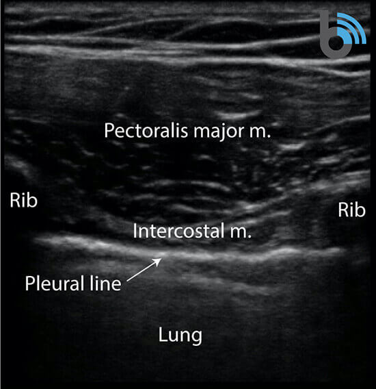 4-Lung-sonoanatomy-linear COVID-19 Lung Ultrasound Scan