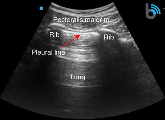 6-Lung-sonoantomy-curved COVID-19 Lung Ultrasound Pleural Line Scan