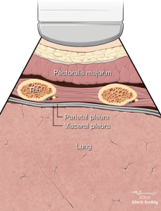 7-Curved-Anatomy_1050x800-229x300 COVID-19 Lung Ultrasound Lung Diagram