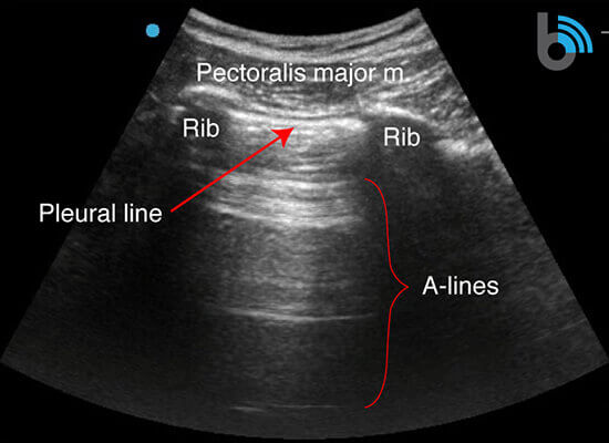 8-Lung-A-lines COVID-19 Lung Ultrasound Scan Diagram