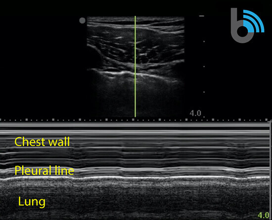 9-M-mode-no-pneumo COVID-19 Lung Ultrasound Scan Chest Wall, Pleural Line & Lung