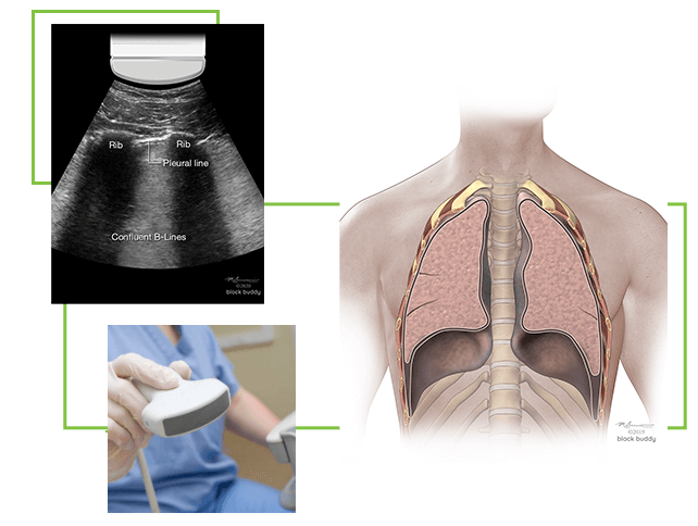 ConferenceLayout COVID-19 Lung Ultrasound Scans & Illustration