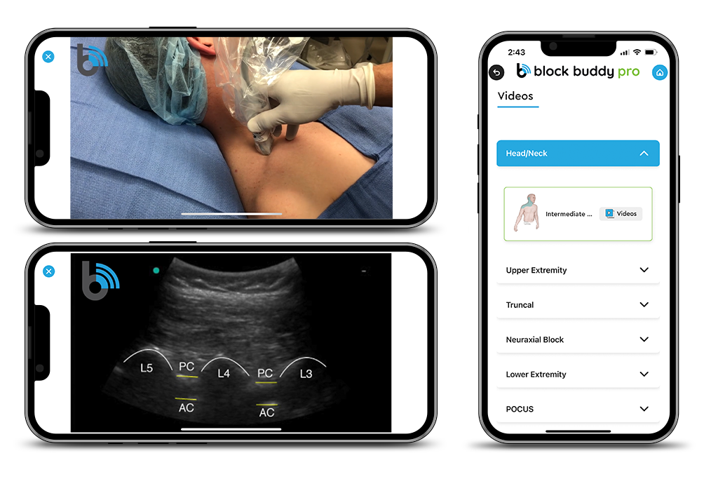 BBP-1024x683-Videos Screen Views of Block Buddy App Videos of Ultrasound Guided Nerve Blocks
