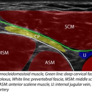 ICPB Intermediate Cervical Plexus Block Scan