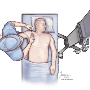 InfraclavicularBlock Infraclavicular Block Procedure Illustration