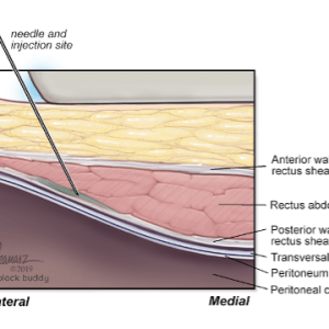 RectusSheathBlock Rectus Sheath Block Illustration