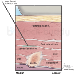 pecs PECS Block Illustration