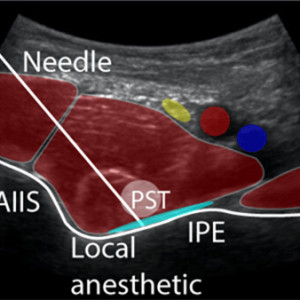peng-1 Pericapsular Nerve Group (PENG) Block Scan