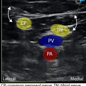 popliteal Popliteal Sciatic Nerve Block Scan