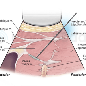ql3 Anterior Quadratus Lumborum (QL3) Illustration